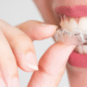 Does Dental Insurance Cover Braces?
